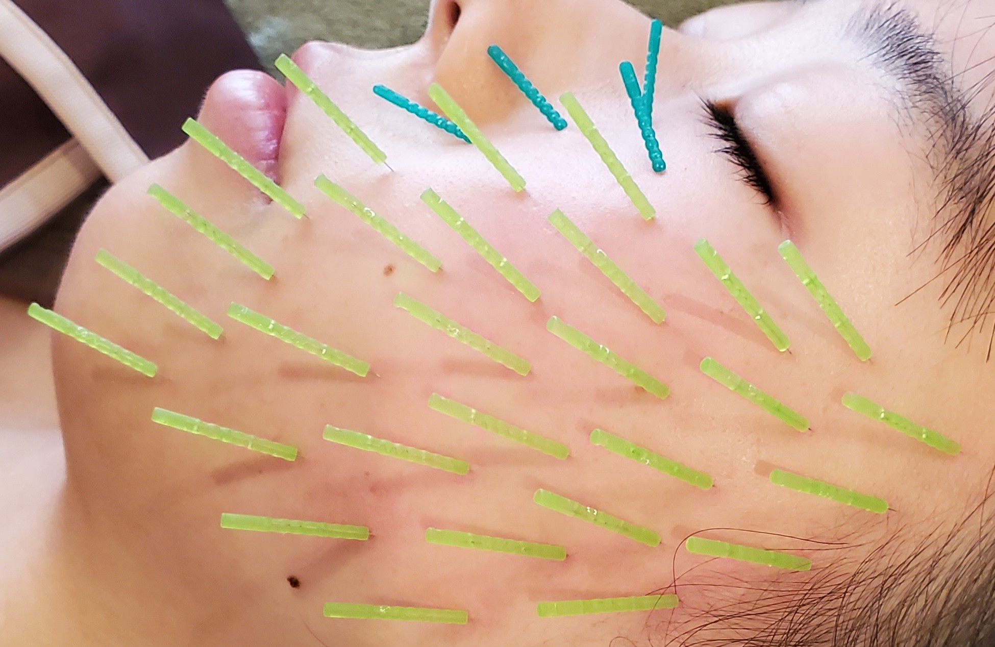 長期アプローチ